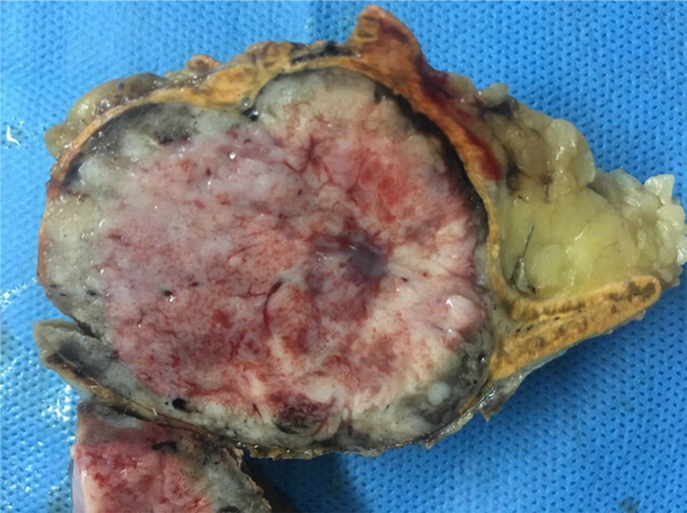 Gross Specimen of the Adrenal Tumor: A Solid and Yellow Oval Mass Gross Specimen of the Adrenal Tumor: A Solid and Yellow Oval Mass