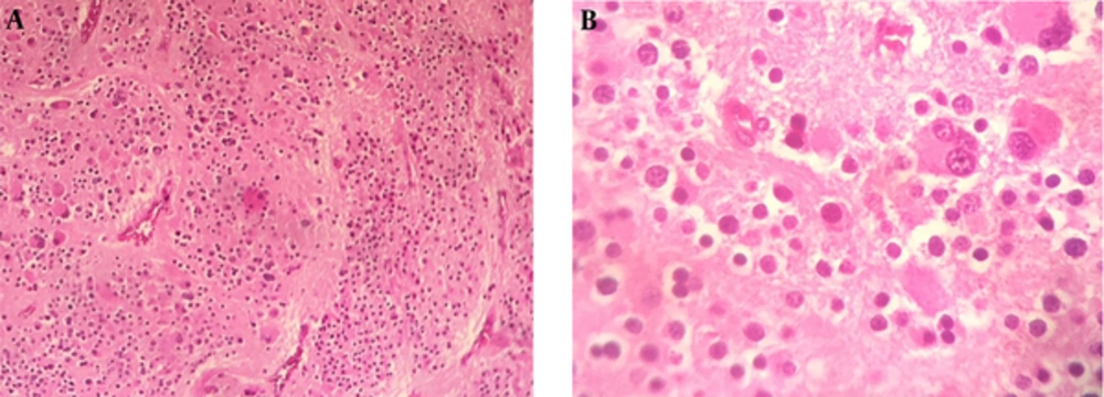 Histologic Examination of the Surgical Specimen Shows Neuroblasts and Ganglion Cells: (A) H and E (× 100); (B): H and E (× 400) Histologic Examination of the Surgical Specimen Shows Neuroblasts and Ganglion Cells: (A) H and E (× 100); (B): H and E (× 400)