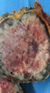 Cover image of the article: Adrenal Ganglioneuroblastoma in an Adult: A Rare Case Report