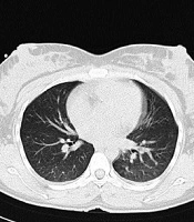 A Case Report of COVID-19 in a Pregnant Woman with Clinical Manifestations of Chorioamnionitis in Ilam, Iran