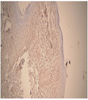 Evaluation of Matrix Metalloproteinases 2 and 9 in Oral Squamous Cell Carcinoma and Verrucous Carcinoma