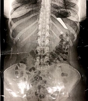 Repeated Intentional Swallowing of Foreign Objects by an Adolescent Girl (Case Report)