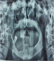 Refusal of Surgical Treatment for Advanced Oral Squamous Cell Carcinoma in a Long-Term Naswar Consumer: A Case Report