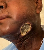 Facial Soft Tissue Damage Resulting from Opium Insertion into Lacerations: A Case Report