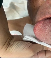 Perioperative Anesthetic Management of Reductive Glossectomy in an Adult Patient Suffer from Hypertention with Macroglossia: A Case Report