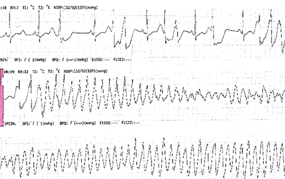 ECG Torsades de Pointes ECG Torsades de Pointes