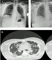 Cover image of the article: Once a Known Veterinary Pathogen, Now a Forgotten Zoonosis. Case Report of An Invasive Staphylococcus intermedius Group Infection