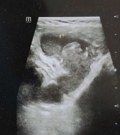 Breast Tuberculosis: A Report of Two Cases
