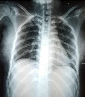 Cover image of the article: Fatality Case in a Tuberculous Meningoencephalitis Patient Coinfected with COVID-19