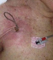 Clinically Focused Review of Diagnosis and Treatment of Cardiovascular Implantable Electronic Device Infections