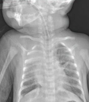 Leukomoid Reaction and Partial Exchange in an Infant with Pertussis