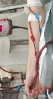 Cover image of the article: The Prevalence of HIV, HCV, and HBV Among Hemodialysis Patients Attending Duhok Hemodialysis Center