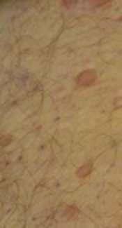 Nocardia cyriacigeorgica: A Case of Disseminated Infection in an Immunocompromised Patient