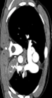Cover image of the article: A 21-Year Old Male with Hemoptysis and Central Chest Pain