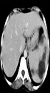 Typhoid Splenic Abscess: A Case Report and Literature Review