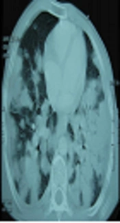 Cover image of the article: Visceral Leishmaniasis with Massive Pulmonary Involvement: A Case Report
