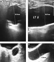 Could Drainage Related Ultrasonography Prevent Unnecessary Interventions in Patients with Wolfram Syndrome?