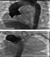 Detection of Coronary Artery Anomaly in Tetralogy of Fallot: Comparison of Two Angiographic Views