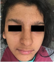 A Report of Incontinentia Pigmenti in an 11-year-old Girl