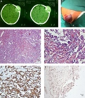 Congenital Angiosarcoma, a Case Report and Review of Literature