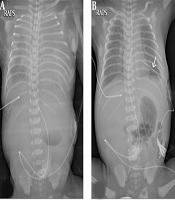 Treatment of Congenital Chylothorax Using High-Dose Octreotide