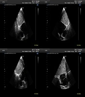 Atrial Septal Defect Device Closure. Is Balloon Sizing Necessary?
