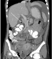 Advanced Gastric Adenocarcinoma in a 12-Year-Old Girl