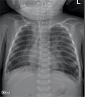 Cover image of the article: Lung Ultrasonography to Diagnose Bronchopulmonary Dysplasia of Premature Infants