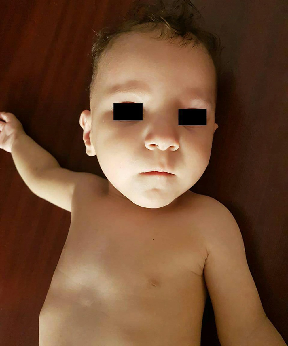 A general picture of the neonate suffered from heart defects related to 10q26 chromosomal deletion A general picture of the neonate suffered from heart defects related to 10q26 chromosomal deletion