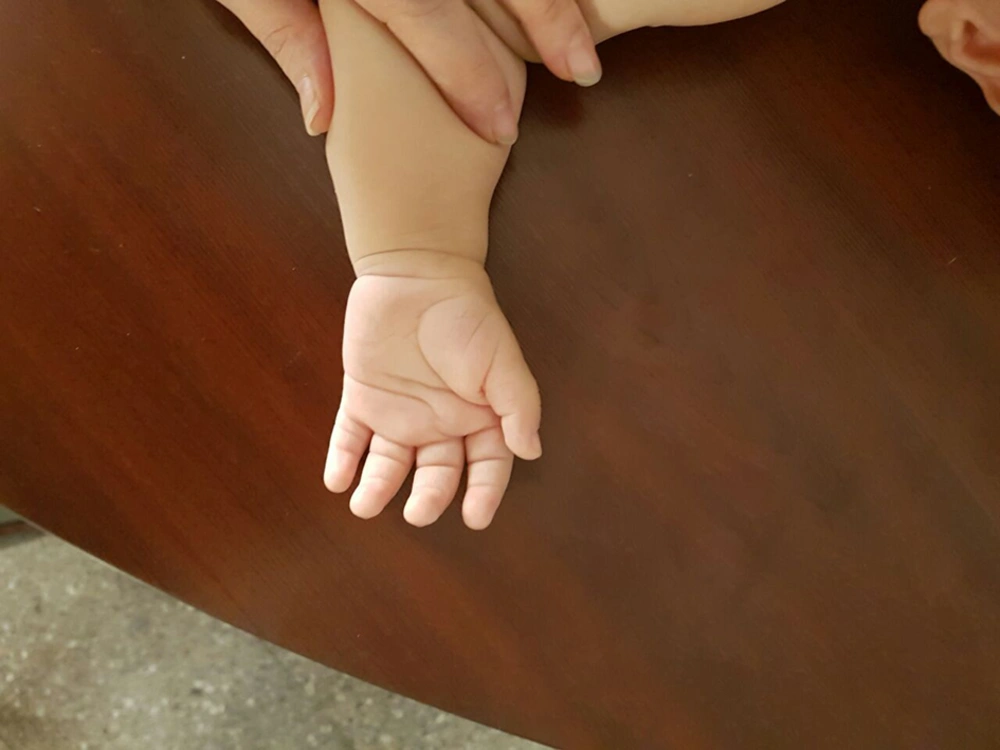 A picture of the hand in the neonate suffered from heart defects related to 10q26 chromosomal deletion A picture of the hand in the neonate suffered from heart defects related to 10q26 chromosomal deletion