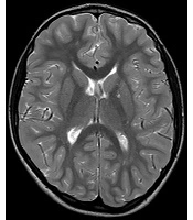 Frameshift Mutation in Polar Rich Domain (PRD) of PQBP1 Gene Associated with Asymmetric Cerebellar Hemispheres: A Case Report of Renpenning Syndrome