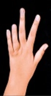 Growth Failure in a Series of Iranian Patients with Juvenile Idiopathic Arthritis
