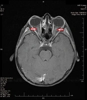 Binocular Optic Neuritis in an Eight-Year-Old Boy Due to COVID-19 Infection