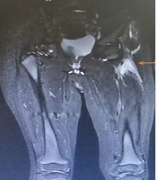 A Boy with Limping and Hip Pain