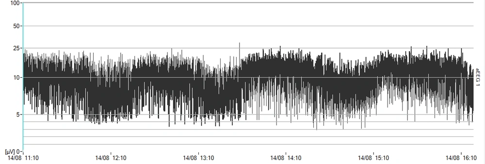 Newborn’s amplitude-integrated electroencephalography under nasal continuous positive airway pressure Newborn’s amplitude-integrated electroencephalography under nasal continuous positive airway pressure