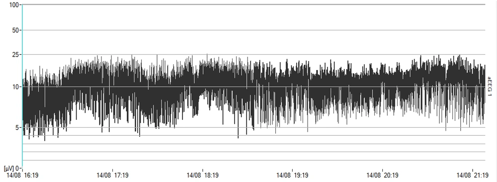 Same newborn’s amplitude-integrated electroencephalography under nasal intermittent positive pressure ventilation Same newborn’s amplitude-integrated electroencephalography under nasal intermittent positive pressure ventilation