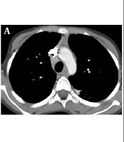 Diagnostic Value of Mediastinal Lymphadenopathy in Differentiating Pulmonary Tuberculosis from Community-Acquired Pneumonia in Children