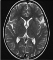 A Girl with Myelopathy and Vision Loss, Misdiagnosis as Neuromyelitis Optica Spectrum Disorder: The First Iranian Case Report on Biotinidase Deficiency