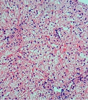 Hereditary Spherocytosis Caused by a Novel Compound Heterozygous Mutation of SPTA1 and Autoimmune Hepatitis in a Pediatric Patient
