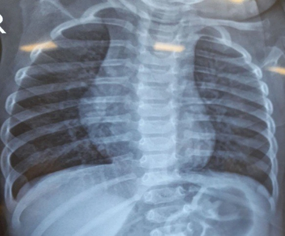 The CXR showing bilateral hyperaeration The CXR showing bilateral hyperaeration
