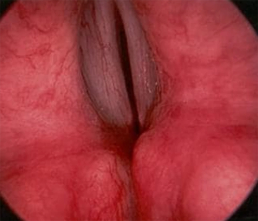 Fiberoptic bronchoscopy: The collapse of flaccid supraglottic structures during inspiration Fiberoptic bronchoscopy: The collapse of flaccid supraglottic structures during inspiration