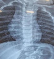 An 11-Year-Old Boy with Dry Cough and Respiratory Distress (from Children’s Medical Center Grand Rand)