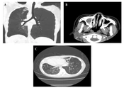 Analysis of Clinical Characteristics and Gene Variants Associated with Primary Ciliary Dyskinesia