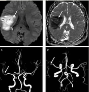 Atrial Septal Defect Device Closure in Patients with Metabolic or Genetic Diseases