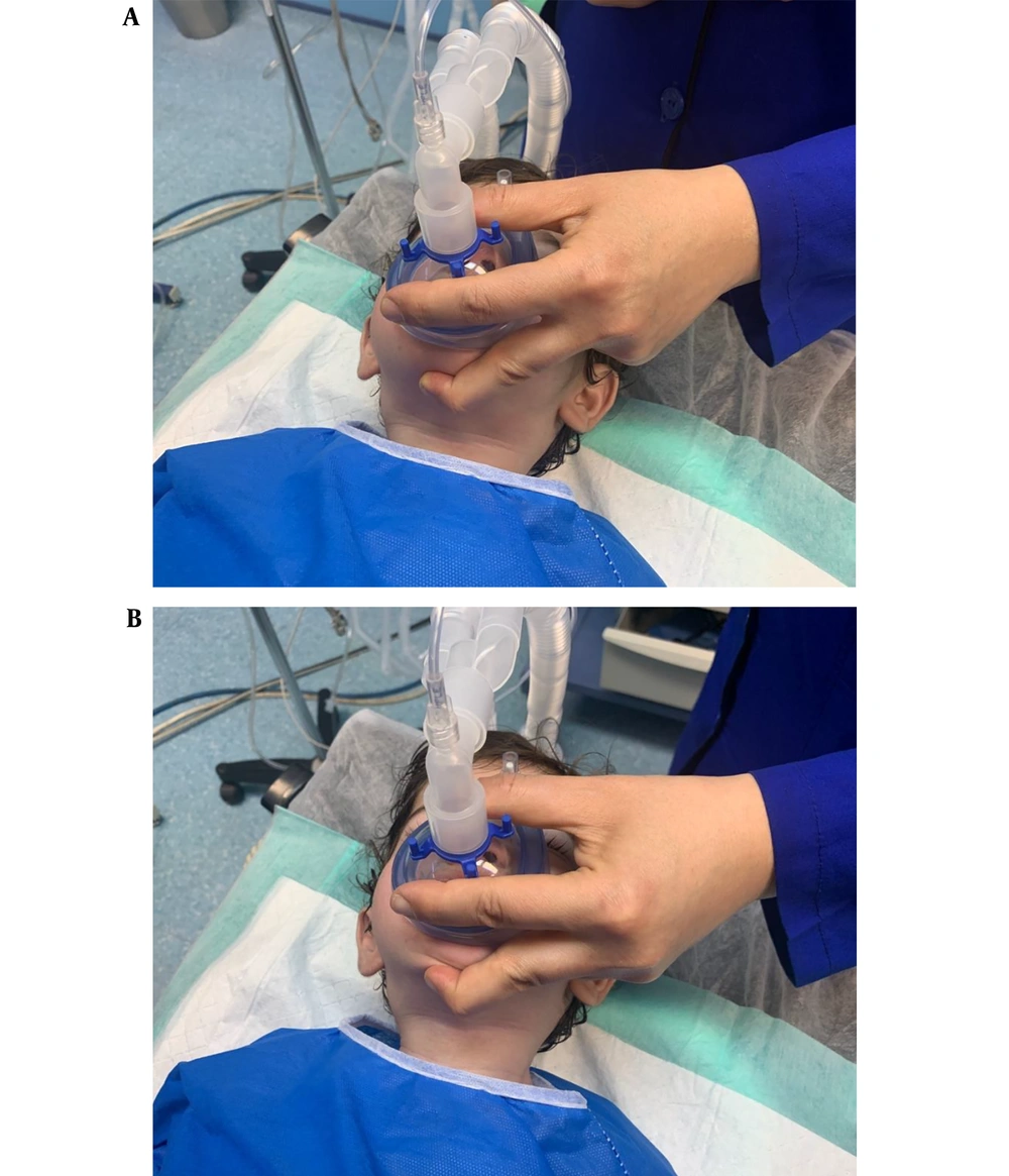 Face mask-holding techniques. A, three-finger grip; B, three-finger grip plus the submental maneuver. With the three-finger grip, the thumb and index finger are placed on the rim of the mask, forming a C shape, and the middle finger is placed on the chin protuberance to lift the chin, while the ring and little fingers are flexed onto the palm and are non-functional in this technique. The submental maneuver is performed by holding and pulling the submental soft tissue upward with the middle finger while maintaining pressure on the chin protuberance. Face mask-holding techniques. A, three-finger grip; B, three-finger grip plus the submental maneuver. With the three-finger grip, the thumb and index finger are placed on the rim of the mask, forming a C shape, and the middle finger is placed on the chin protuberance to lift the chin, while the ring and little fingers are flexed onto the palm and are non-functional in this technique. The submental maneuver is performed by holding and pulling the submental soft tissue upward with the middle finger while maintaining pressure on the chin protuberance.