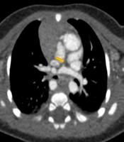 Association of Cardiac Anomalies in Pediatric Dextrocardia: A CT Angiographic Study