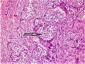 Cover image of the article: Clinico-Pathological Characteristics and Long-Term Outcomes of Incidental Appendiceal Carcinoid Tumors in Children