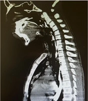 Spontaneous Pneumomediastinum in Children: Underdiagnosis and Overtreatment