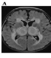 Comparison of Acute COVID-19 Encephalopathy with Seasonal Influenza A-associated Encephalopathy
