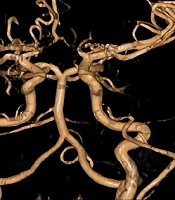 Sevoflurane Sedation for Postoperative Endocranial MRI in a Six-Year-Old Boy with Moyamoya Angiopathy: A Case Report